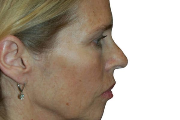 Neck Lift Patient 10 - Before - 1 Carousel Thumbnail