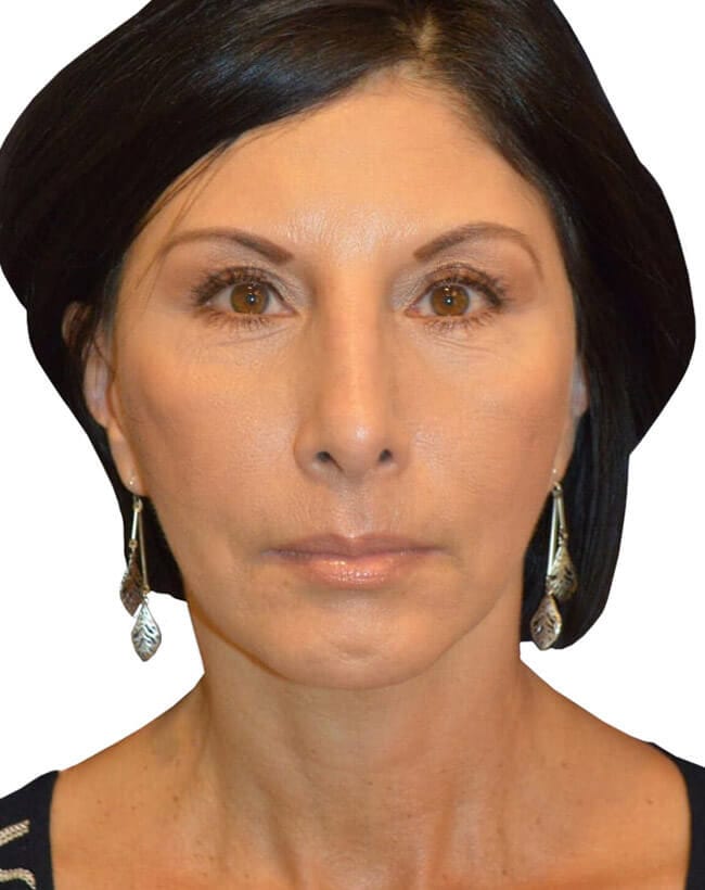 Neck Lift Patient 11 - After - 2