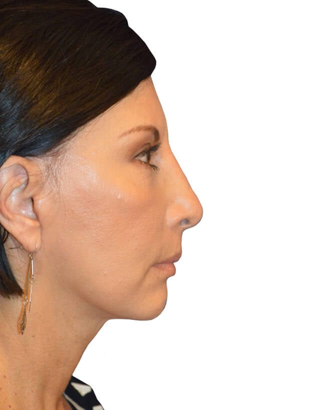 Neck Lift Patient 11 - After - 1