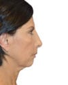 Neck Lift Patient 11 - Before - 1 thumbnail