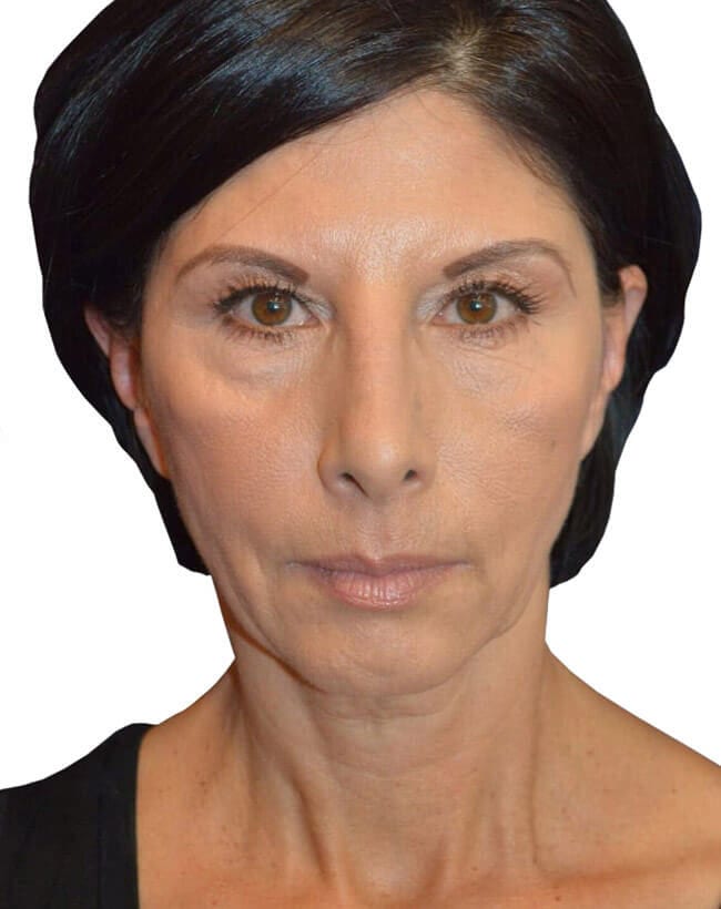 Neck Lift Patient 11 - Before - 2