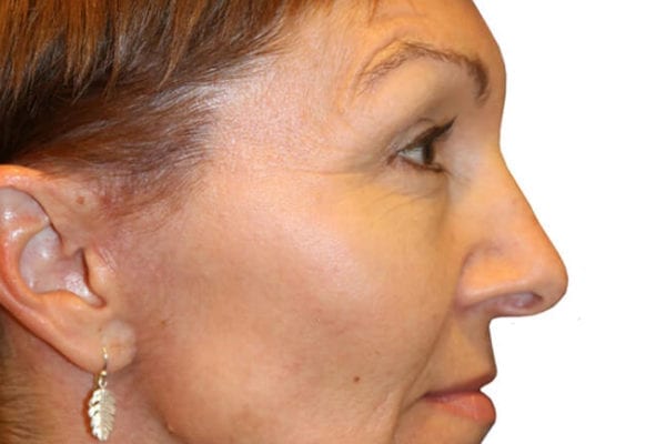 Neck Lift Patient 12 - After - 1 Carousel Thumbnail