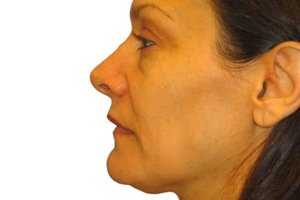 Neck Lift Patient 02 - Before - 1 Carousel Thumbnail