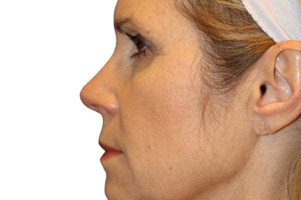 Neck Lift Patient 04 - Before - 1 Carousel Thumbnail