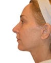 Neck Lift Patient 05 - After - 1 thumbnail