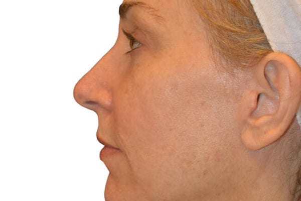 Neck Lift Patient 05 - After - 1 Carousel Thumbnail