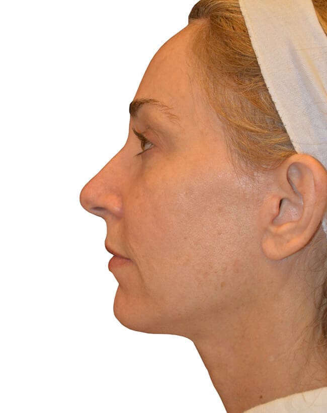 Neck Lift Patient 05 - After - 1