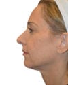 Neck Lift Patient 05 - After - 1 thumbnail