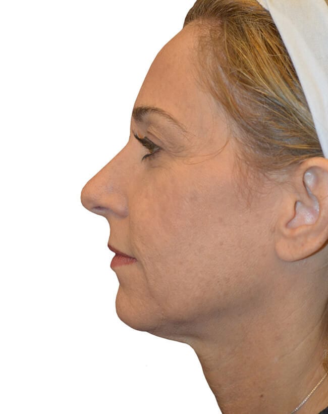 Neck Lift Patient 05 - After - 2