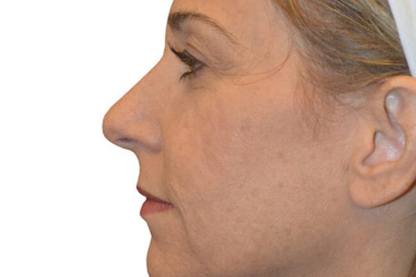 Neck Lift Patient 05 - Before - 1 Carousel Thumbnail