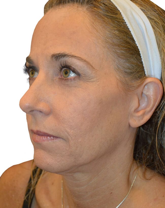 Neck Lift Patient 05 - Before - 2