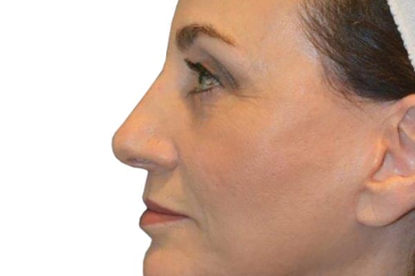 Neck Lift Patient 07 - After - 1 Carousel Thumbnail