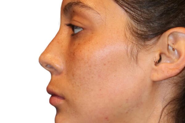 The Diamond Facial Sculpting Patient 13 - After - 1 Carousel Thumbnail