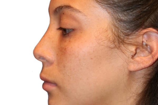 The Diamond Facial Sculpting Patient 13 - Before - 1 Carousel Thumbnail