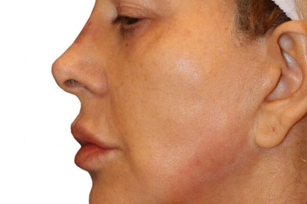 The Diamond Facial Sculpting Patient 14 - After - 1 Carousel Thumbnail