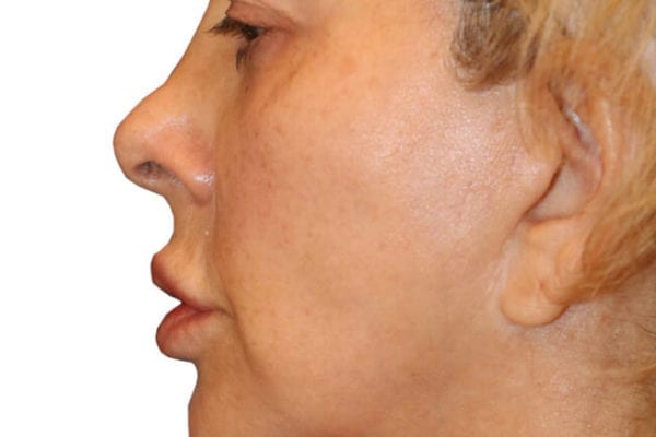 The Diamond Facial Sculpting Patient 14 - Before - 1 Carousel Thumbnail