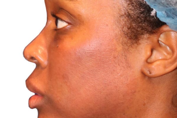 The Diamond Facial Sculpting Patient 15 - After - 1 Carousel Thumbnail