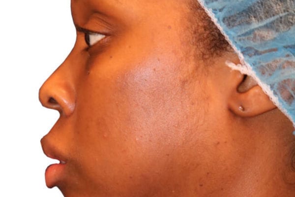 The Diamond Facial Sculpting Patient 15 - Before - 1 Carousel Thumbnail