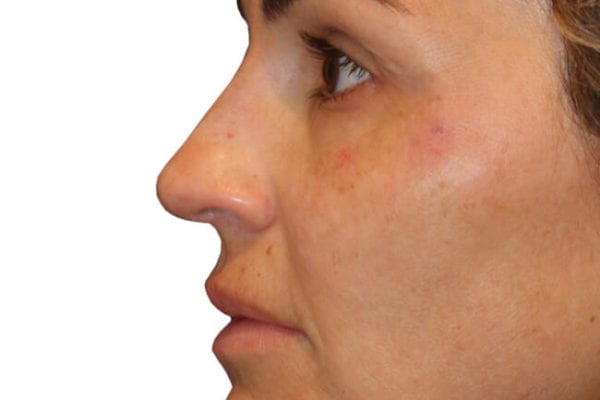 The Diamond Facial Sculpting Patient 16 - After - 1 Carousel Thumbnail