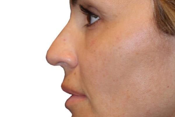 The Diamond Facial Sculpting Patient 16 - Before - 1 Carousel Thumbnail