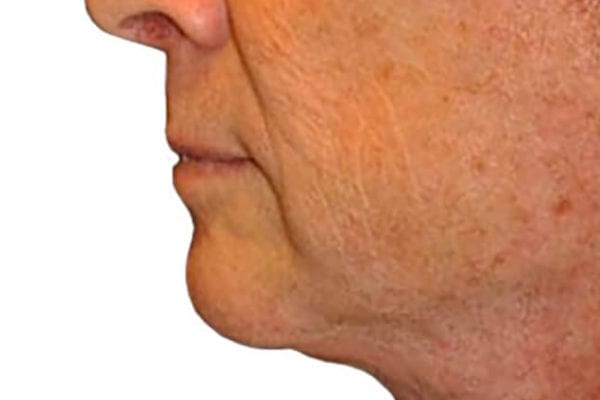 Neck Lift Patient 14 - After - 1 Carousel Thumbnail