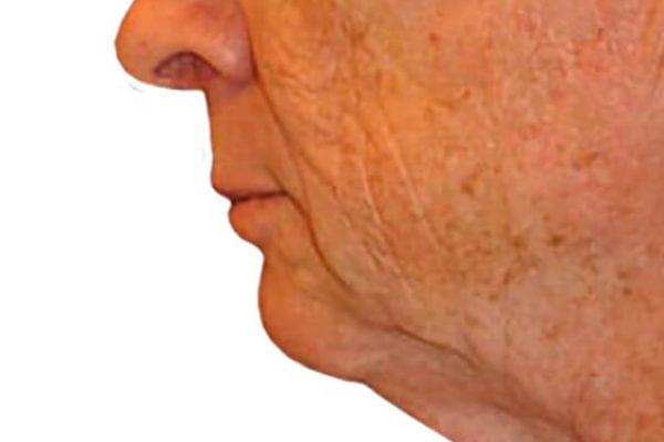 Neck Lift Patient 14 - Before - 1 Carousel Thumbnail