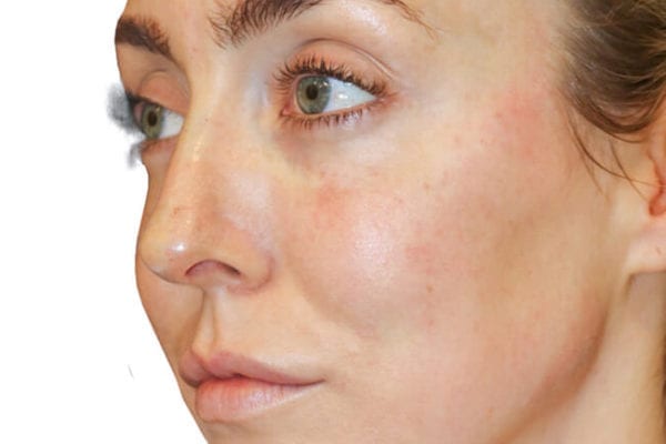 The Diamond Facial Sculpting Patient 17 - After - 1 Carousel Thumbnail