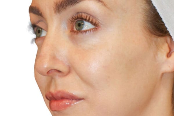 The Diamond Facial Sculpting Patient 17 - Before - 1 Carousel Thumbnail