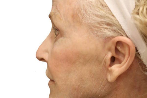 Facelift Patient 20 - After - 1 Carousel Thumbnail