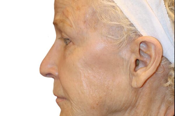 Facelift Patient 20 - Before - 1 Carousel Thumbnail