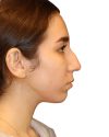Rhinoplasty Patient 18 - Before - 1 thumbnail