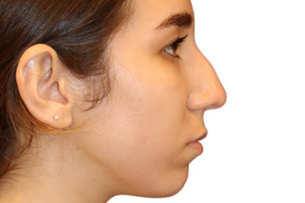Rhinoplasty Patient 18 - Before - 1 Carousel Thumbnail