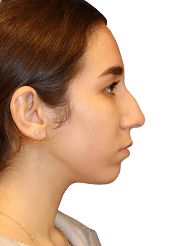 Rhinoplasty Patient 18 - Before - 1