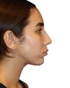 Rhinoplasty Patient 18 - After - 1 thumbnail