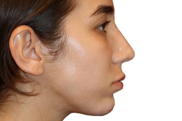 Rhinoplasty Patient 18 - After - 1 Carousel Thumbnail