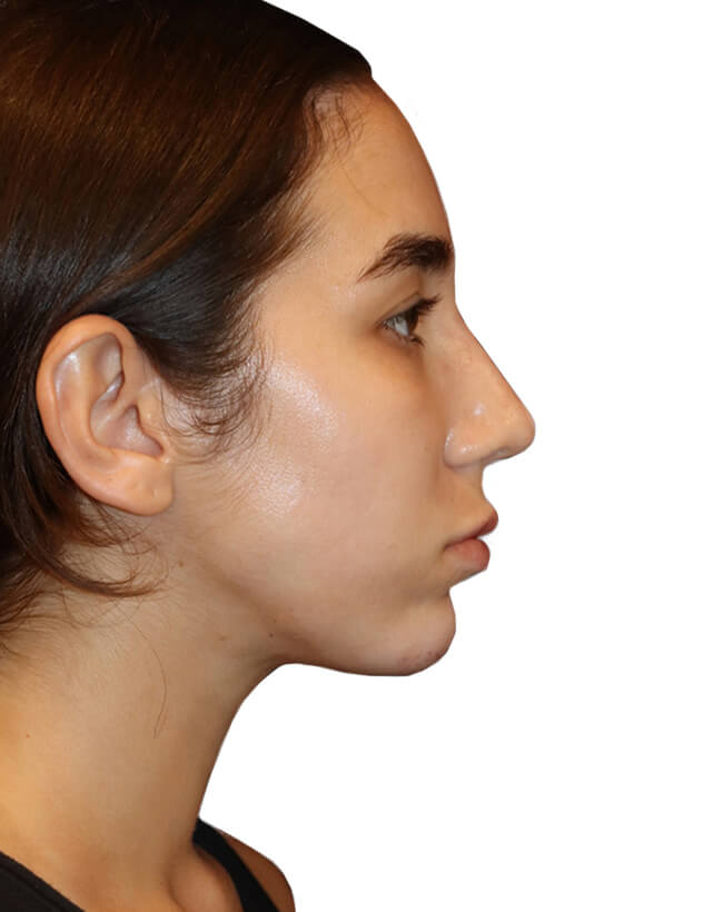 Rhinoplasty Patient 18 - After - 1