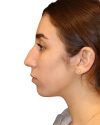 Rhinoplasty Patient 18 - Before - 1 thumbnail