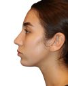Rhinoplasty Patient 18 - After - 1 thumbnail
