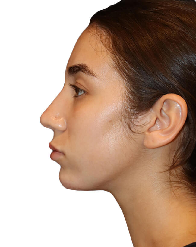 Rhinoplasty Patient 18 - After - 4