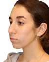 Rhinoplasty Patient 18 - Before - 1 thumbnail
