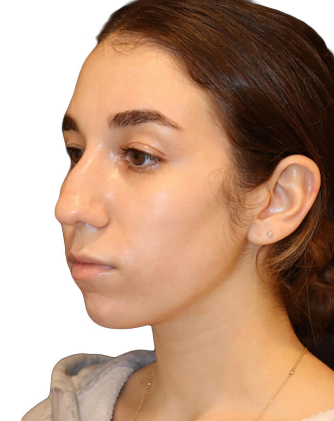 Rhinoplasty Patient 18 - Before - 3