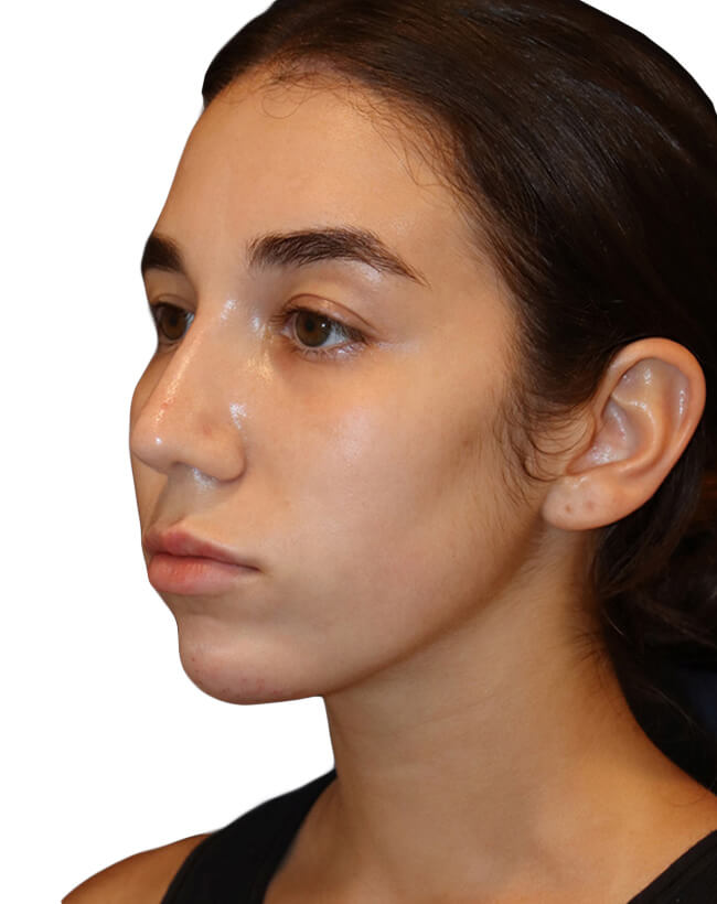 Rhinoplasty Patient 18 - After - 3