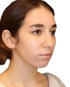 Rhinoplasty Patient 18 - Before - 1 thumbnail