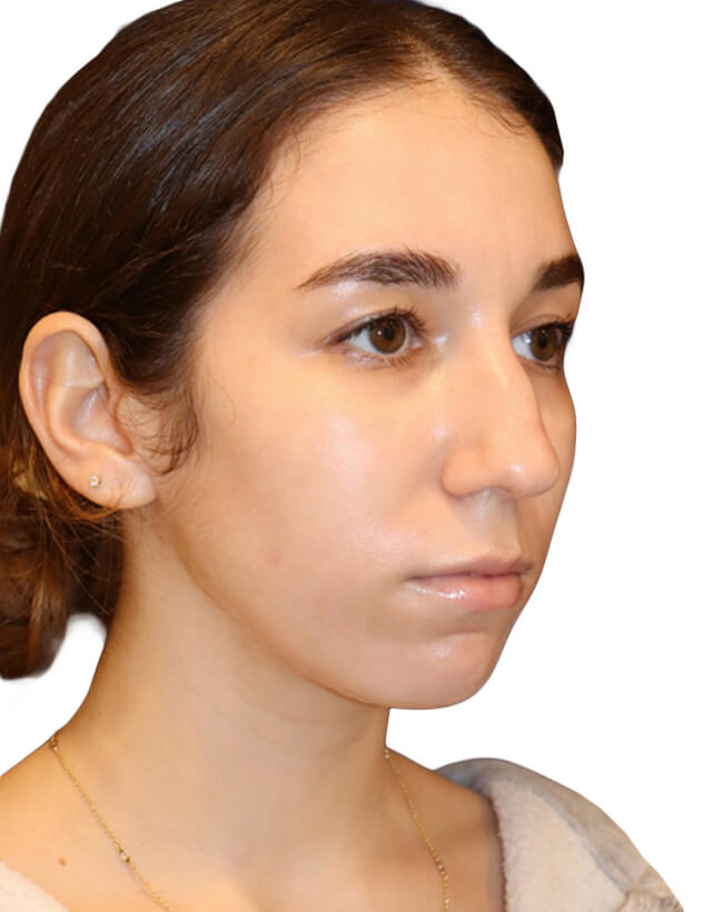Rhinoplasty Patient 18 - Before - 2