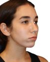 Rhinoplasty Patient 18 - After - 1 thumbnail