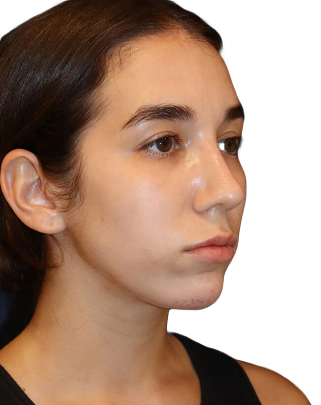 Rhinoplasty Patient 18 - After - 2