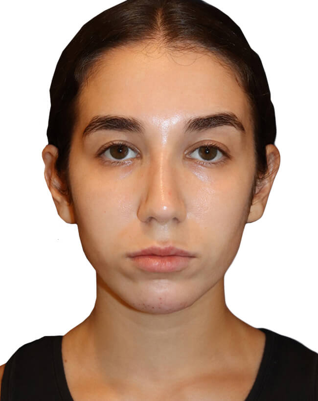 Rhinoplasty Patient 18 - After - 5