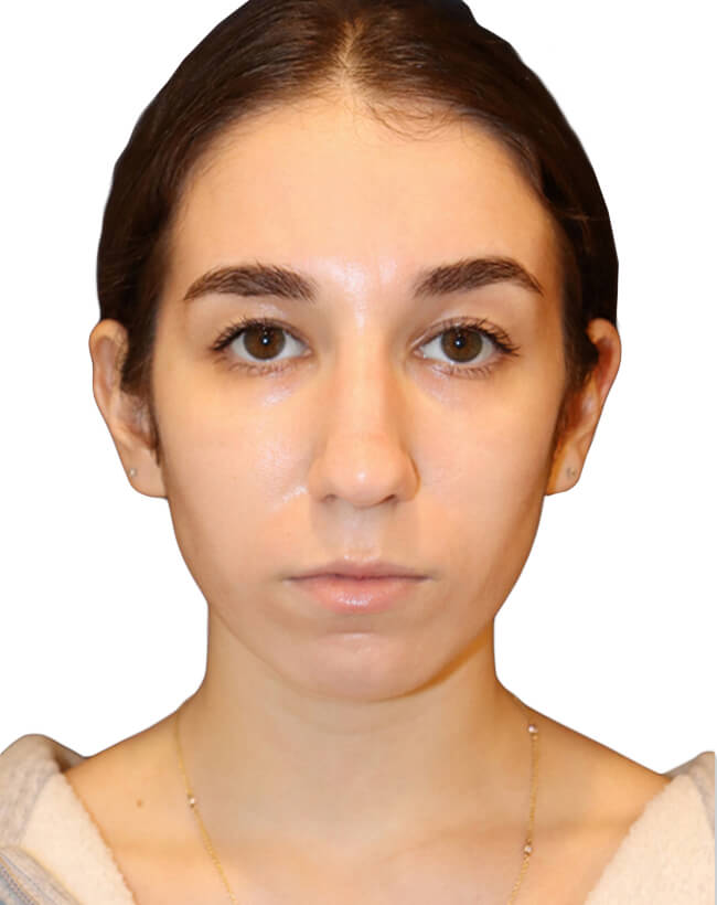 Rhinoplasty Patient 18 - Before - 5