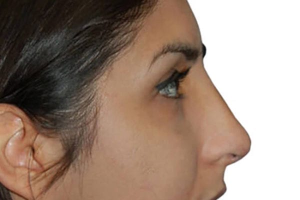 Rhinoplasty Patient 01 - After - 1 Carousel Thumbnail