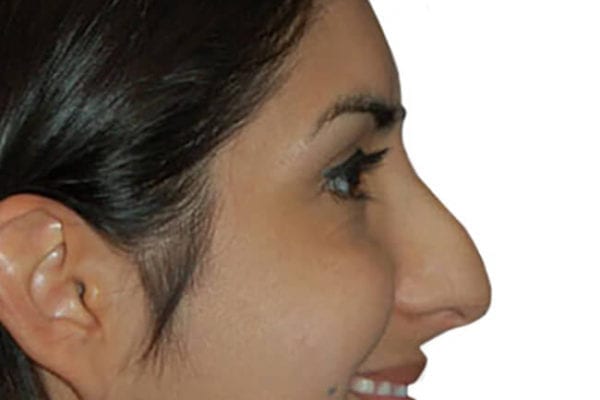 Rhinoplasty Patient 01 - Before - 1 Carousel Thumbnail